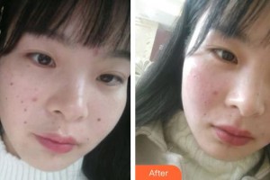 郴州瑞澜医疗美容医院但汗乾整形价格表附激光点痣案例展示