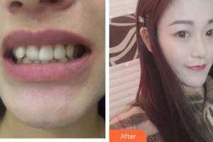 郴州瑞澜医疗美容医院王莉整形价格表附牙贴面案例展示