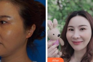 南方医院整形美容科高建华整形价格表附射频紧肤案例展示