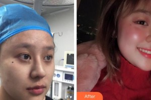 南方医院整形美容科冯传波整形价格表附埋线提升案例展示