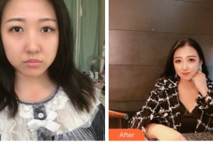 南方医院整形美容科张立宪整形价格表附埋线提升案例展示