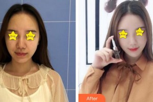 南方医院整形美容科温公佳住院医师整形价格表附埋线提升案例展示