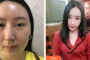 南方医院整形美容科黎小间整形价格表附埋线提升案例展示