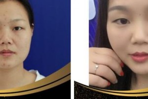 南方医院整形美容科陈其庆住院医师整形价格表附埋线提升案例展示