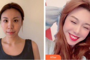 南方医院整形美容科杨澄宇住院医师整形价格表附埋线提升案例展示