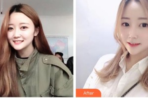 南方医院整形美容科胡振富整形价格表附埋线提升案例展示