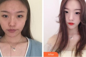 南方医院整形美容科鲁峰整形价格表附埋线提升案例展示