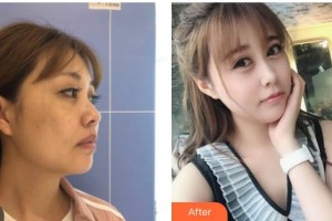 南方医院整形美容科罗勇整形价格表附埋线提升案例展示