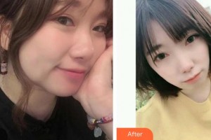 南方医院整形美容科胡志奇整形价格表附热拉提案例展示