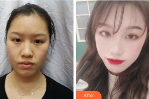 白求恩国际和平医院整形美容中心杨建民整形价格表附埋线提升案例展示