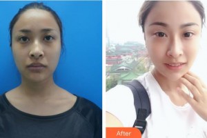 白求恩国际和平医院整形美容中心李晓东整形价格表附埋线提升案例展示