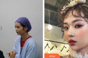 白求恩国际和平医院整形美容中心安亮恩整形价格表附埋线提升案例展示