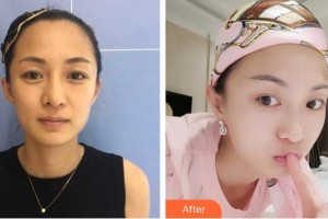 白求恩国际和平医院整形美容中心赵晓程整形价格表附埋线提升案例展示