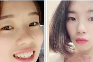 乐清牙科医院赵亚飞整形价格表附牙齿隐形矫正案例展示