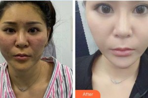 暨南大学附属第一医院整形美容激光中心李康英  整形价格表附牙齿陶瓷矫正案例展示