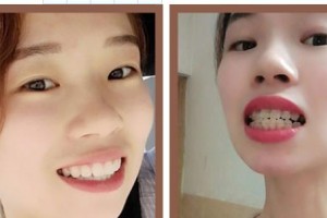 暨南大学附属第一医院整形美容激光中心谢波 整形价格表附牙齿隐形矫正案例展示