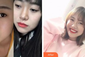 八大处整形医院国贸门诊部吕唯整形价格表附牙齿隐形矫正案例展示