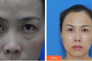 永康康利眼科医院王晓鹏整形价格表附切开双眼皮案例展示
