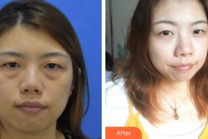 永康东方医疗美容诊所马聪整形价格表附激光去眼袋案例展示