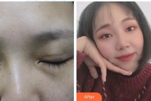 永康常春藤医疗美容诊所陈珺怡整形价格表附眼部修复案例展示