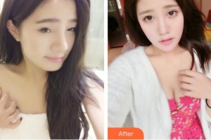 永康康利眼科医院毛欣杰整形价格表附埋线双眼皮案例展示