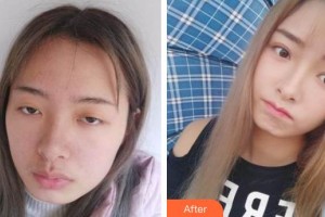 永康胡韵口腔门诊部杨玲燕整形价格表附切开双眼皮案例展示