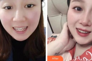 永康胡韵口腔门诊部杨文雅整形价格表附牙齿隐形矫正案例展示