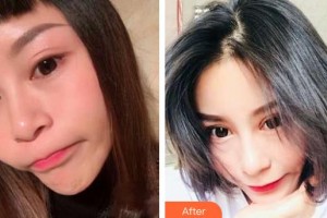 永康康利眼科医院王开元整形价格表附切开双眼皮案例展示