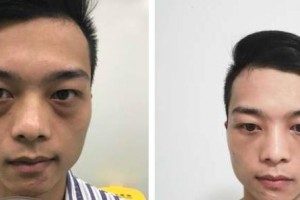 永康康利眼科医院余野整形价格表附激光去眼袋案例展示