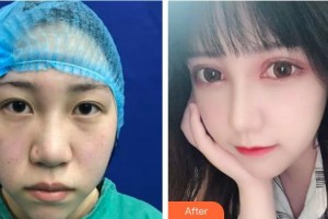 永康康利眼科医院施灵毅整形价格表附切开双眼皮案例展示