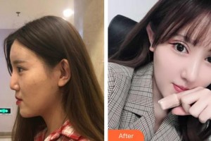 清远养和整形美容医院李超整形价格表附鼻部综合案例展示