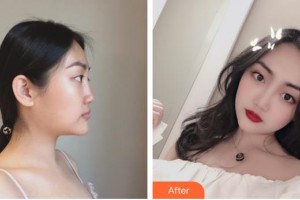 清远市人民医院整形美容科唐夏住院医师整形价格表附耳软骨复合隆鼻案例展示