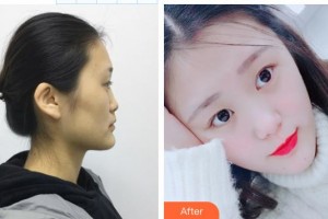 清远养和整形美容医院余娇整形价格表附鼻部综合案例展示
