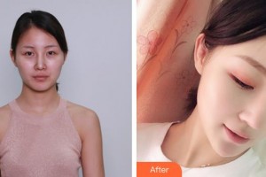 清远养和整形美容医院徐新星整形价格表附鼻部综合案例展示