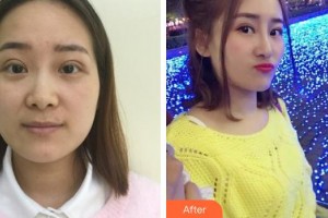 清远华美整形外科门诊部丘金俊整形价格表附鼻部综合案例展示