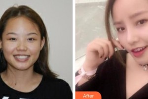 南华大学附属第二医院医疗美容科曾健整形价格表附鼻部综合案例展示