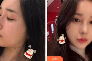 南华大学附属第二医院医疗美容科蒋斌整形价格表附鼻骨矫正案例展示