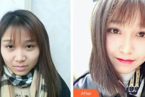 南华大学附属第二医院医疗美容科刘志坤整形价格表附鼻部综合案例展示