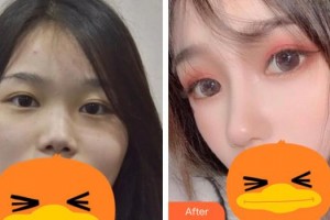 南华大学附属第二医院医疗美容科肖霞整形价格表附鼻部综合案例展示