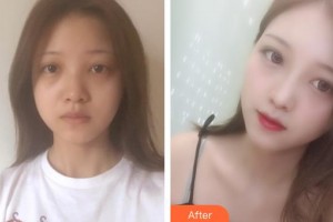 佛山华厦眼科医院刘祖国整形价格表附眼部整形双眼皮案例展示