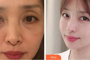 佛山华厦眼科医院张弛整形价格表附眼部综合案例展示