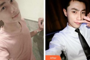 武夷山丽姿医疗美容医院朴炳春整形价格表附鼻部综合案例展示