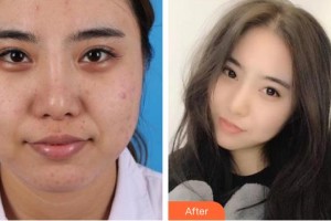 武夷山丽姿医疗美容医院朴良洙整形价格表附假体隆鼻案例展示