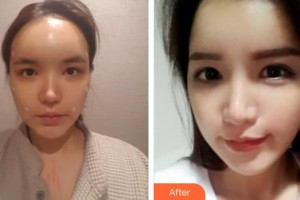 皖北煤电集团总医院医学美容中心杨州整形价格表附鼻部综合案例展示