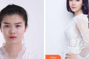 皖北煤电集团总医院医学美容中心刘艳菊整形价格表附假体隆鼻案例展示