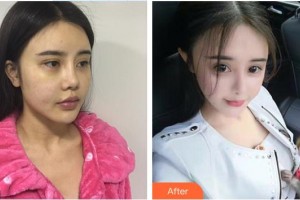 皖北煤电集团总医院医学美容中心钱国庆整形价格表附鼻部综合案例展示