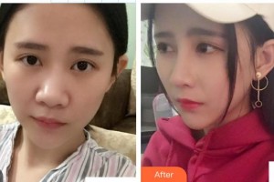 皖北煤电集团总医院医学美容中心朱晓云整形价格表附鼻部综合案例展示