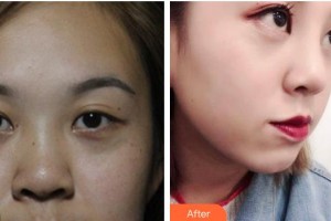 皖北煤电集团总医院医学美容中心毛秋影住院医师整形价格表附鼻部综合案例展示