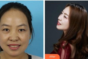 皖北煤电集团总医院医学美容中心盛玮洁住院医师整形价格表附耳软骨复合隆鼻案例展示