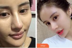 皖北煤电集团总医院医学美容中心周冰如住院医师整形价格表附鼻部综合案例展示